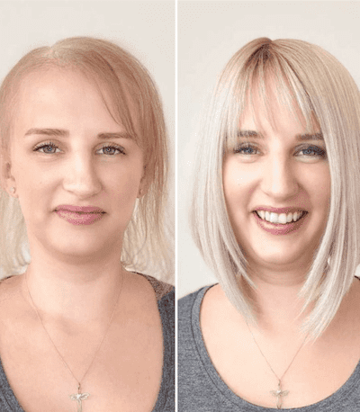 Les MicroLines, solution révolutionnaire et alternative aux perruques et toupets, apportent du volume à votre chevelure grâce à des cheveux naturels sains et vigoureux.